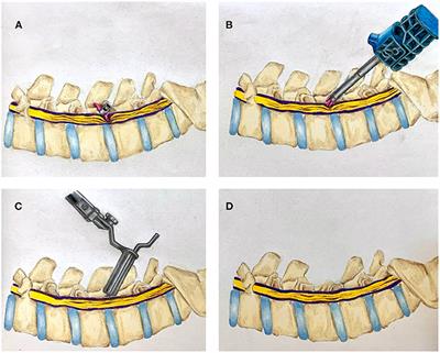 Neurosurgical Management of Interspinous Device Complications: A Case Series